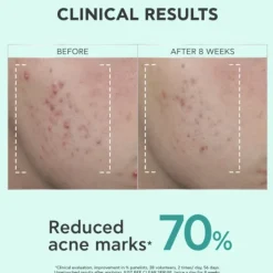 Apivita Just Bee Clear Sérum Anti-Imperfeições 30ml | Atenua Marcas Acne e Afina a Pele